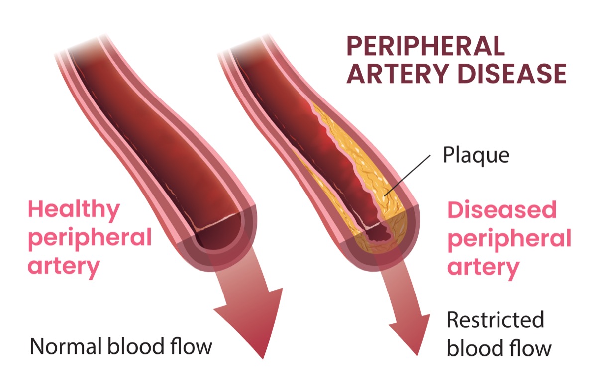 Peripheral Artery Disease