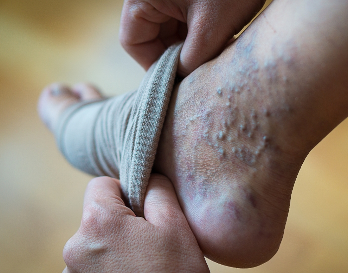 do compression socks help with varicose veins