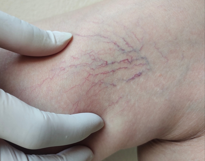 what are spider veins