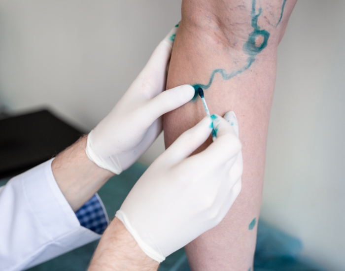 varicose vein treatment in feet
