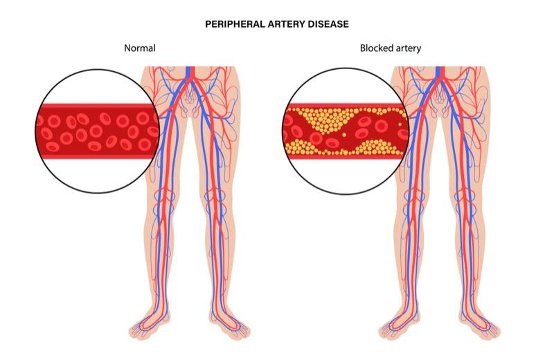 Peripheral artery disease diagram