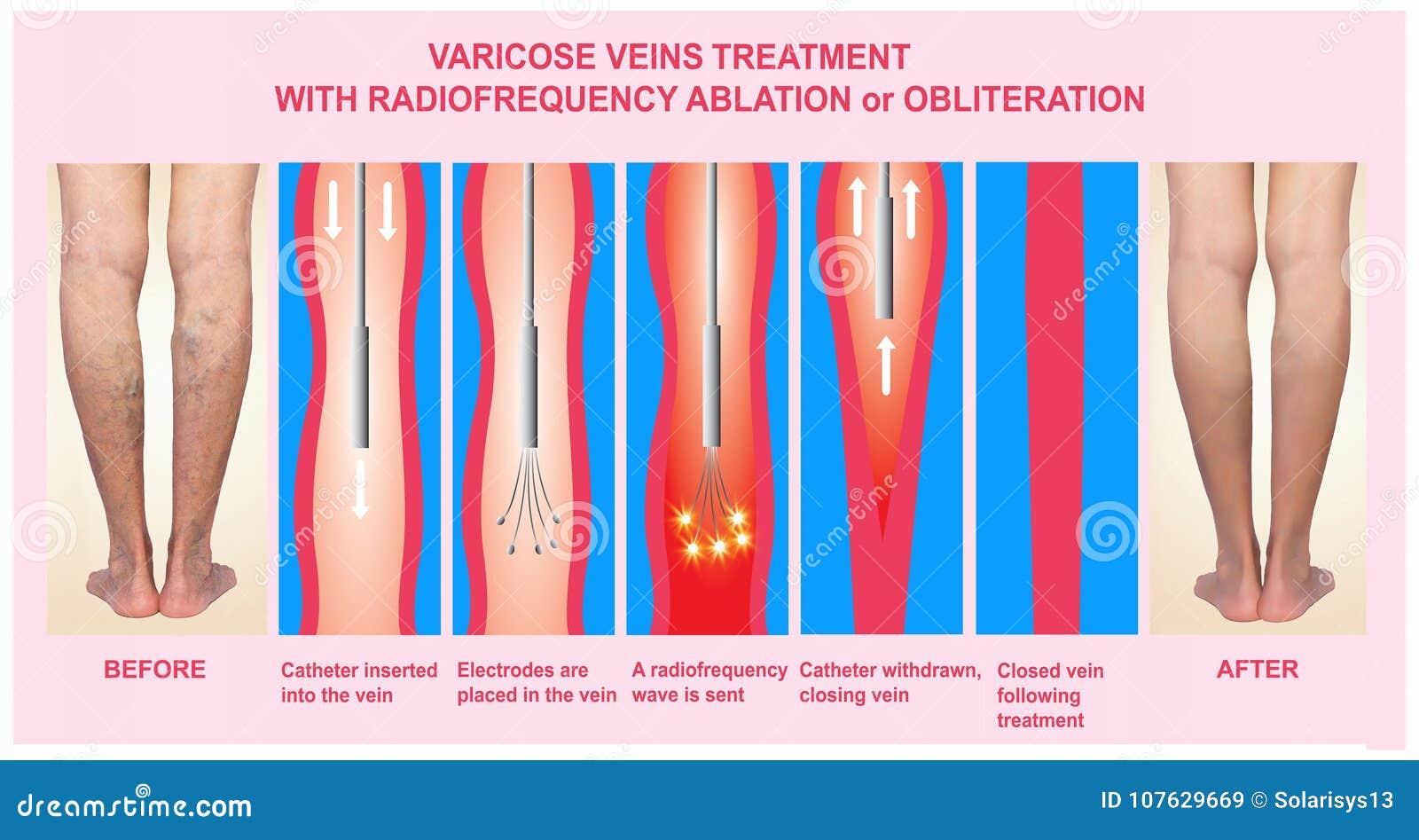 Varicose vein treatment at Cypress Cardiovascular Institute in Cypress, TX