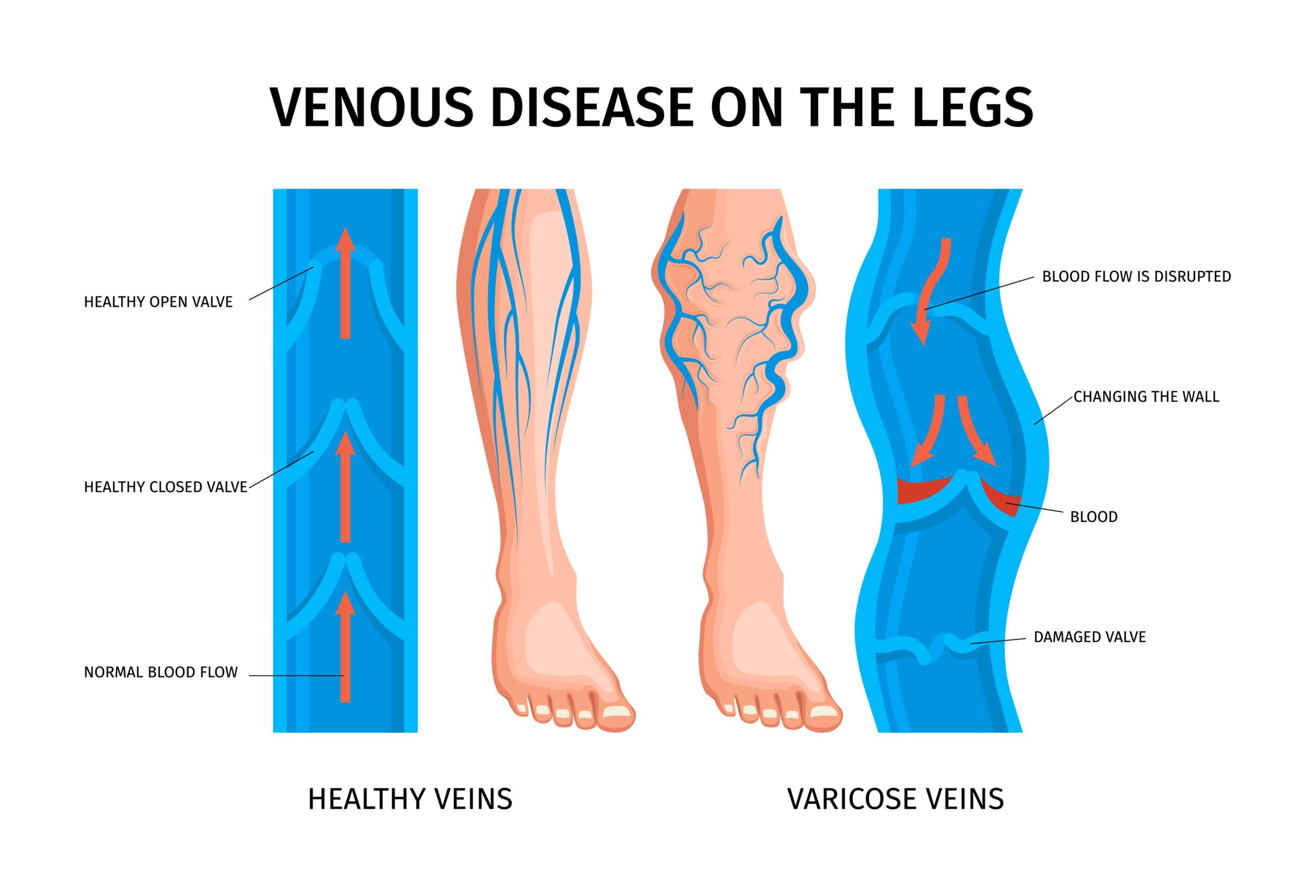 Venous disease on the leg